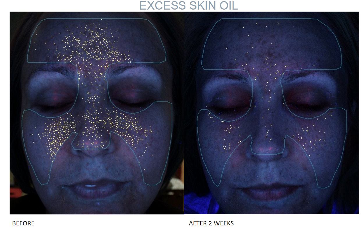 Acne Prone Treatment Kit