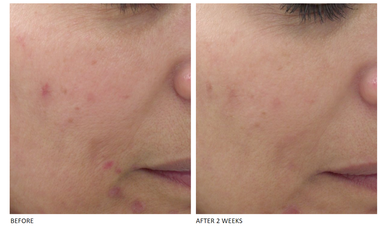 Acne Prone Treatment Kit