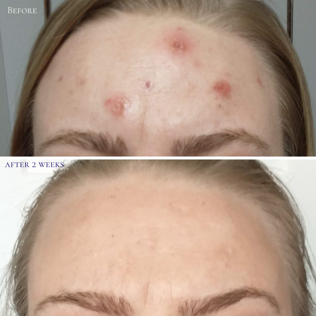 Probiotic Clarifying Home Peel .5 oz