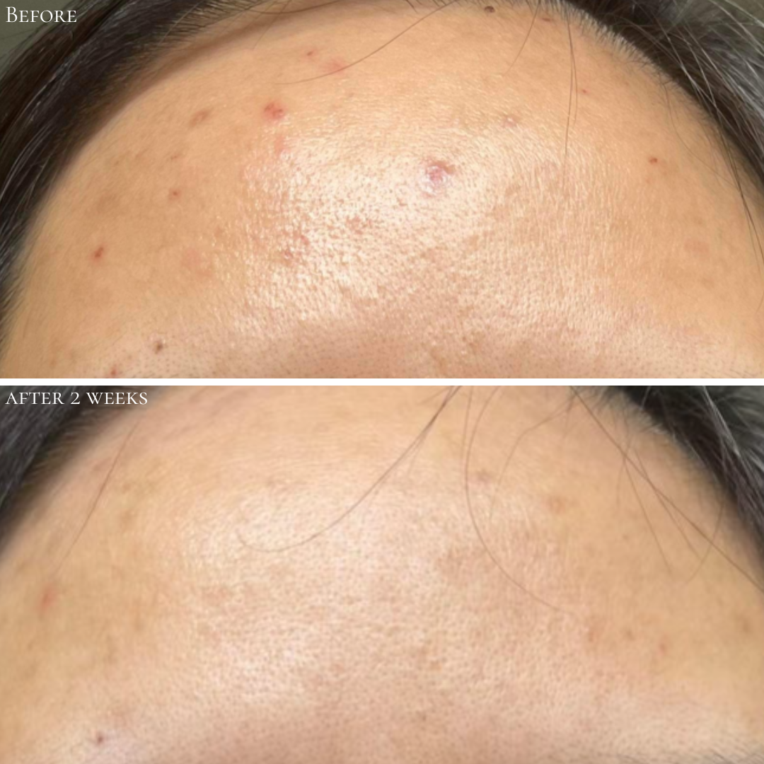 Probiotic Clarifying Home Peel .5 oz