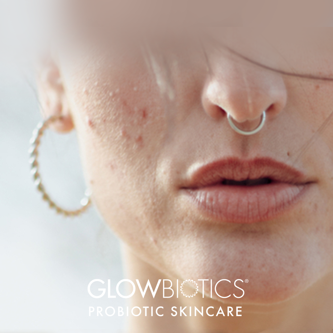 Products to Help Combat Adult Acne