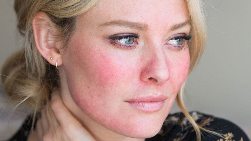 Balancing Rosacea & Redness