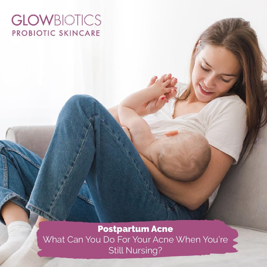Postpartum Acne What Can You Do For Your Acne When You're Still Nursing?
