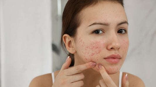 5 Different Causes of Acne