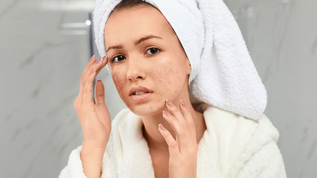 Why Does Your Acne Keep Coming Back