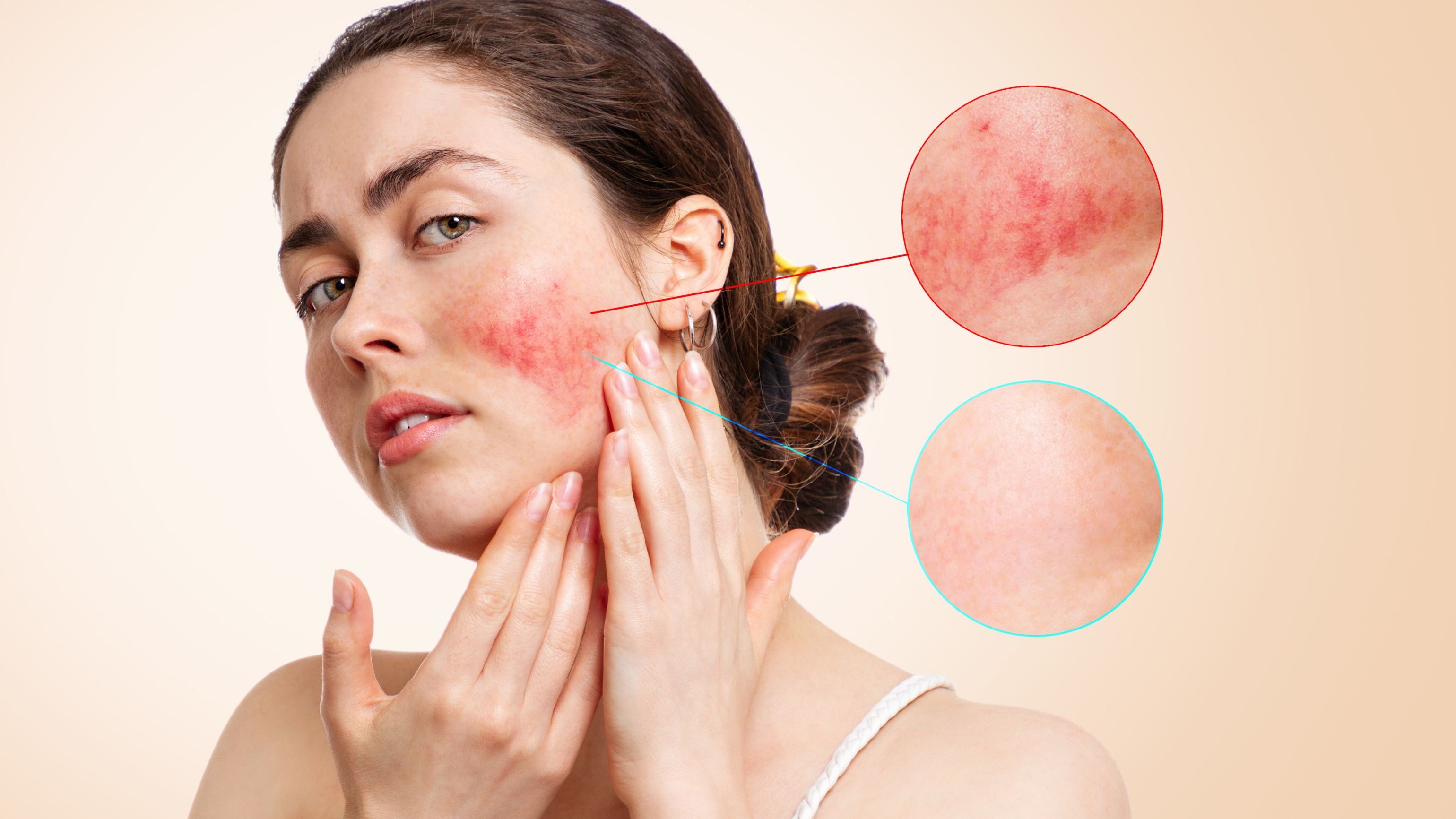 What is Rosacea? | Symptoms, Causes, & Treatment