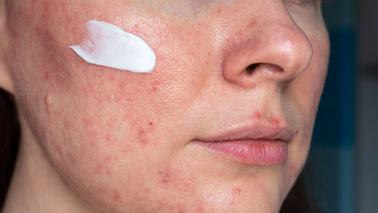 Defending Against Flare-Ups: Sunscreen Essentials for Rosacea Care