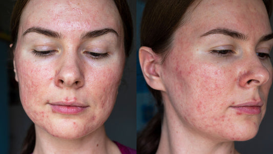 What is Papulopustular Rosacea?