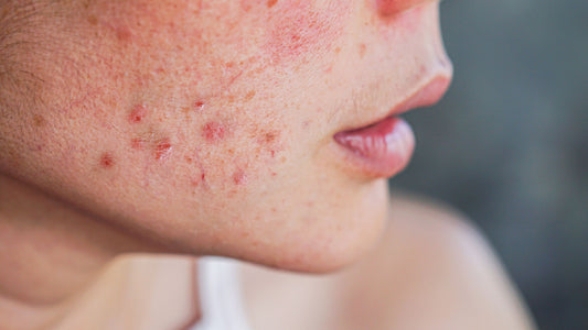 Reclaim Your Glow: Treatments for Papulopustular Rosacea