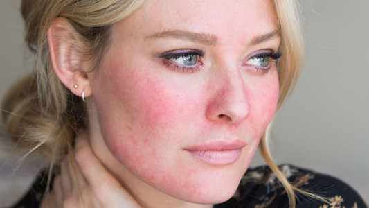 Papulopustular Rosacea vs. Acne: What’s The Difference?