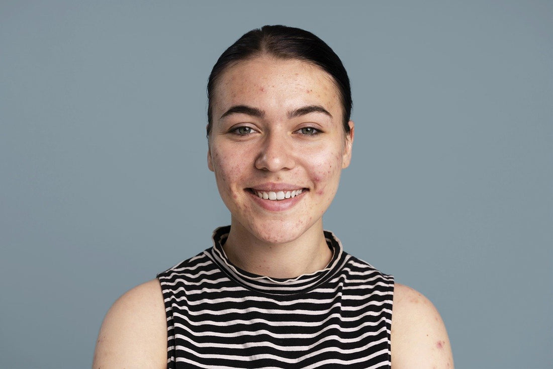 Understanding Skin Inflammation and its Impact on Acne-Prone Skin