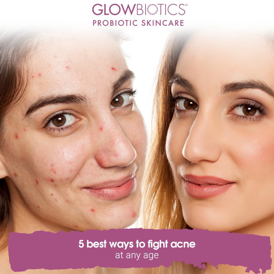 5 Best Ways To Fight Acne At Any Age