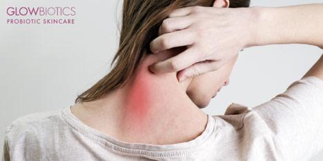 Fighting Redness and Irritation With Good Bacteria