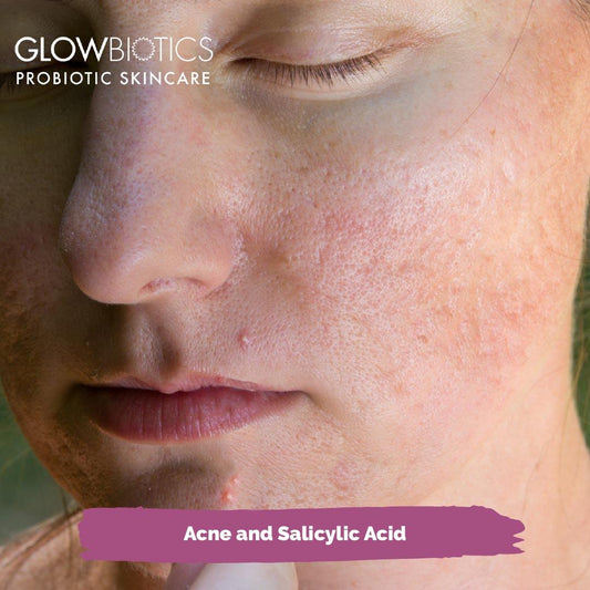 Acne and Salicylic Acid