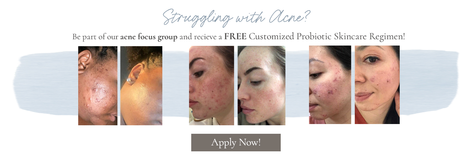 Acne Prone