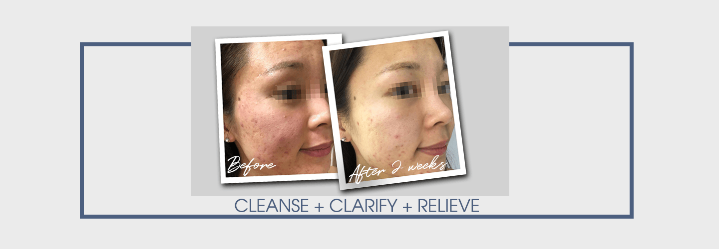 Anti-Acne