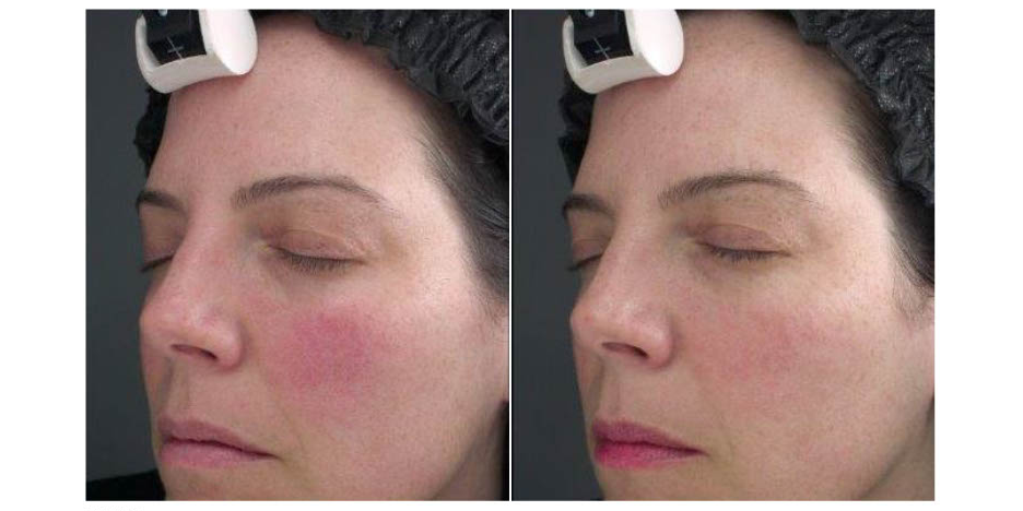 does glutathione help rosacea Cream, Licorice Derivative, and Azelaic Acid Improves Facial Rosacea Care Strategie: Effective Management