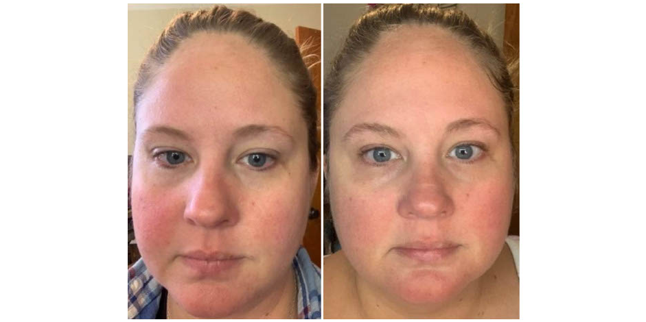 does glutathione help rosacea From red to radiant. 5 best treatments for Medicube PDRN Pink Glutathione Serum