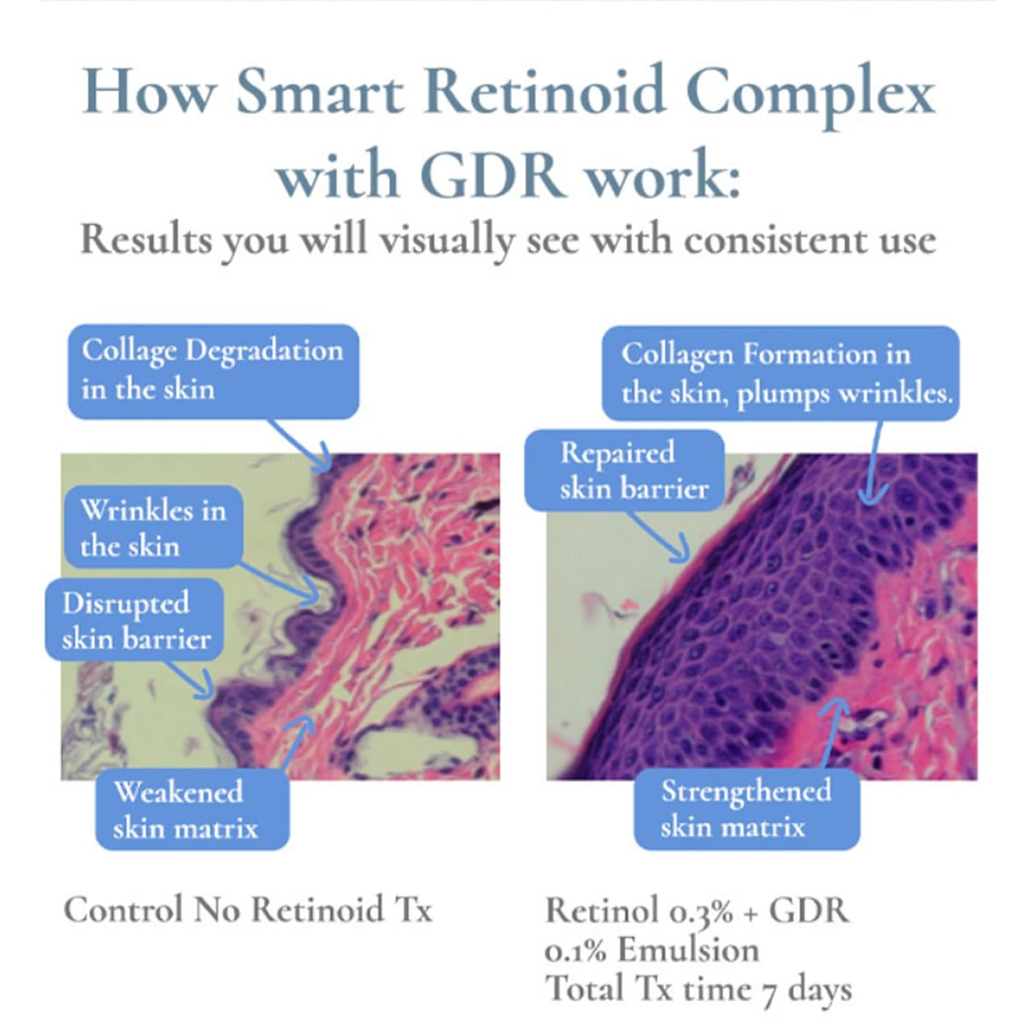 Infographic showing skin improvements with Smart Retinoid Complex and GDR versus control