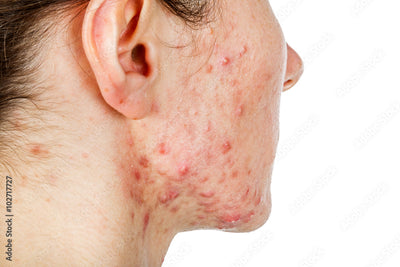 Severe acne