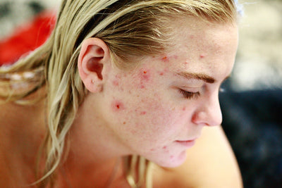 Inflammatory acne