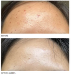 Side-by-side before and after close-ups of forehead showing smoother skin after 6 weeks of use