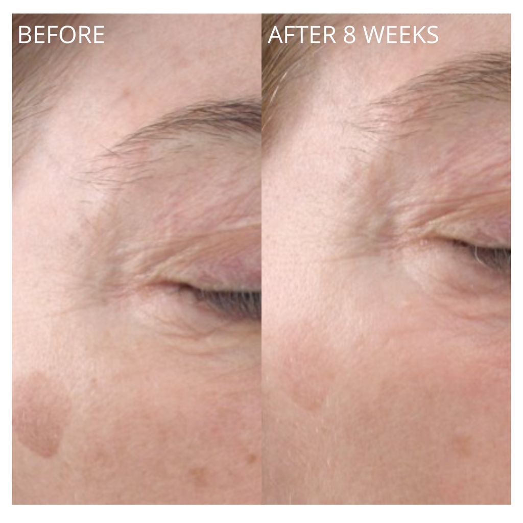 Before and after results of eye area after 8 weeks of serum use