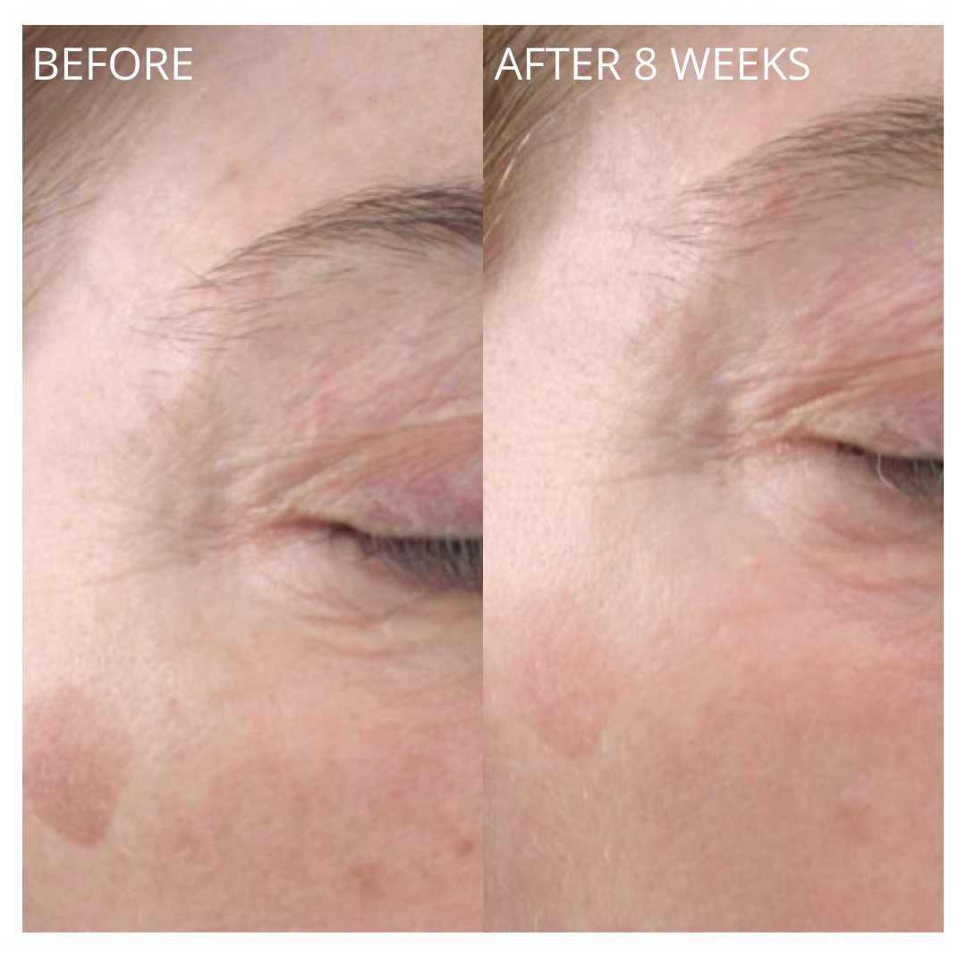 Before and after results of eye area after 8 weeks of serum use