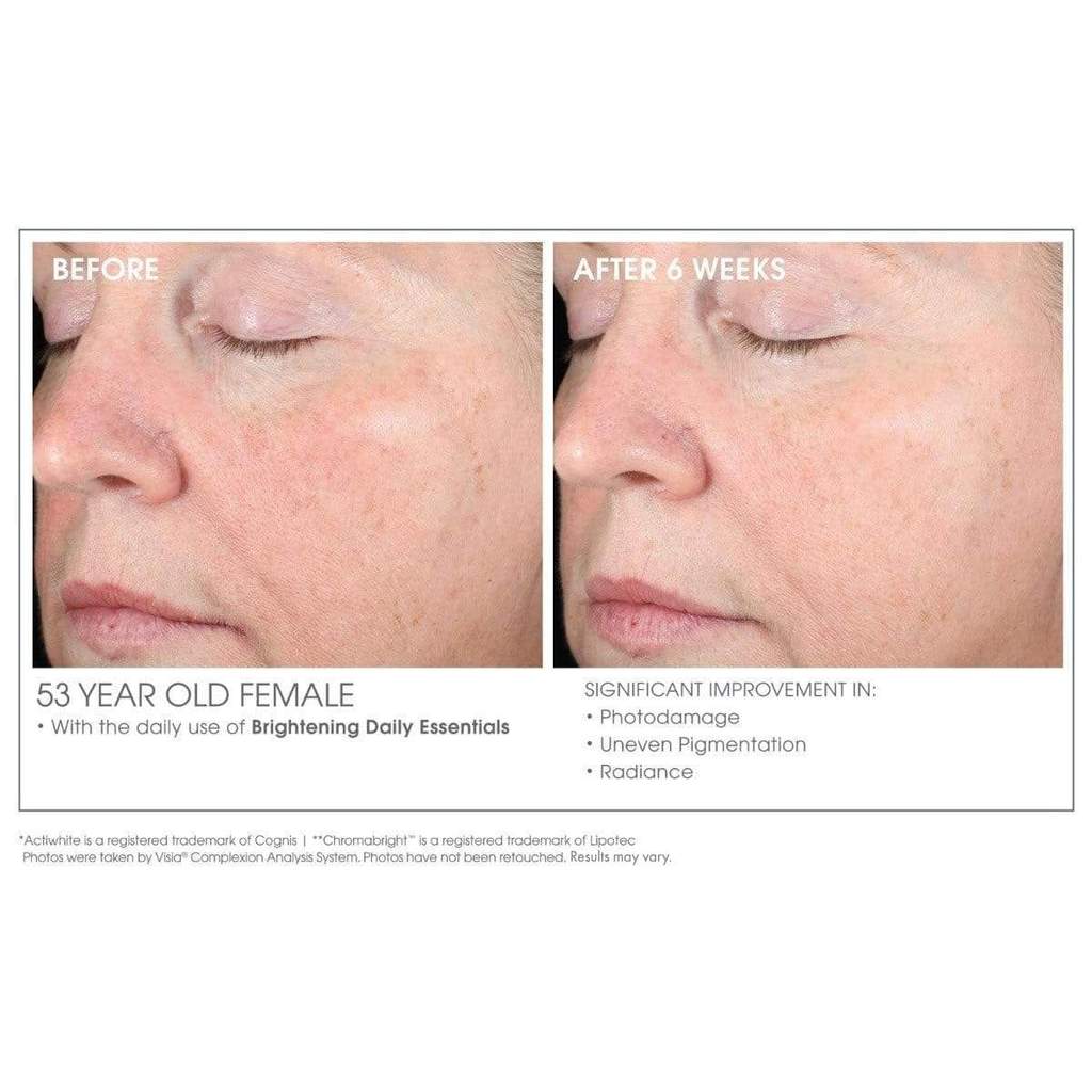 Before and after results of a 55-year-old female’s cheek area after 8 weeks