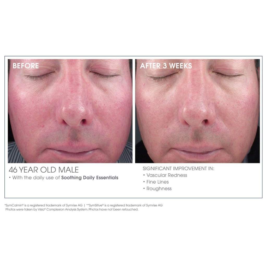 Before and after showing reduced facial redness and irritation after using Glowbiotics Calming Restorative Treatment