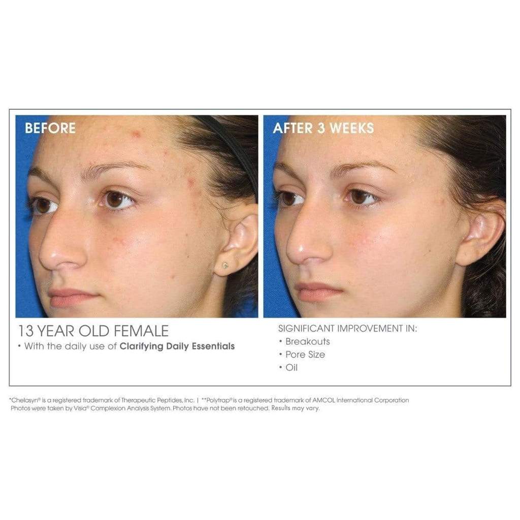 Before and after results after 3 weeks using Glowbiotics Acne Clarifying and Refining Treatment