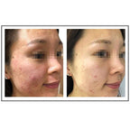 Before and after comparison of female with visible acne improvement after using Glowbiotics Calming Restorative Treatment