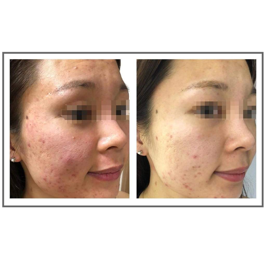 Before and after comparison of female with visible acne improvement after using Glowbiotics Calming Restorative Treatment