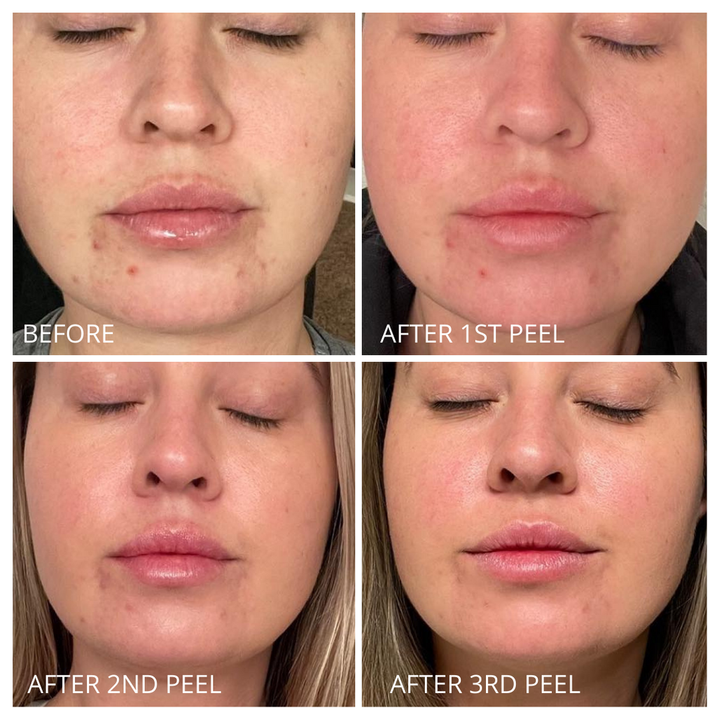 Probiotic Clarifying Home Peel  EXPIRED