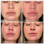 Probiotic Clarifying Home Peel  EXPIRED
