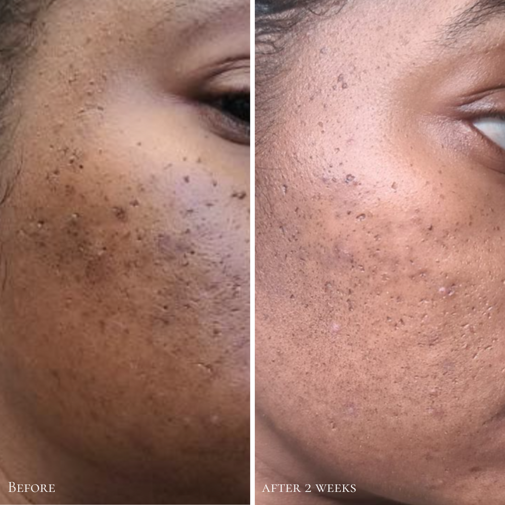 Side-by-side before and after close-ups of cheek area showing improvement in skin texture and clarity after 2 weeks of use