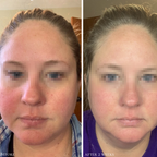 Before and after showing improved skin tone and reduced redness after using Glowbiotics Calming Restorative Treatment