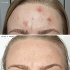 Probiotic Clarifying Home Peel  EXPIRED