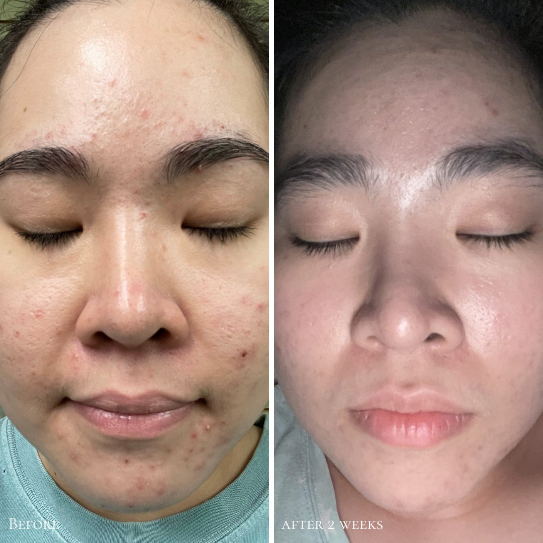 Side-by-side before and after images of a woman’s face showing clearer skin after using Glowbiotics Probiotic Triple Action Clarifying Pads