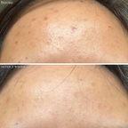 Probiotic Clarifying Home Peel  EXPIRED